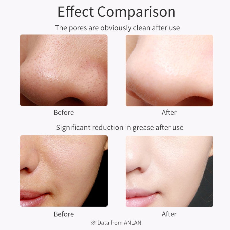 Effect comparison of Ultrasonic Skin Scrubber showing clean pores and reduced grease; before and after images.